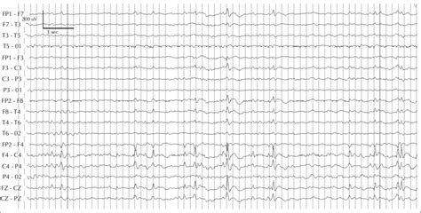 Interictal Sleep Eeg Recording At Age 17 Years Showing Frequent