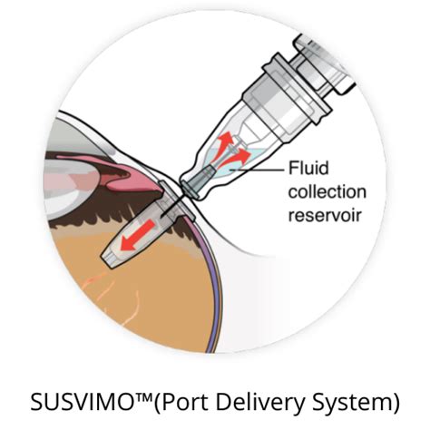 Implant May Replace Monthly Injections For Wet Amd Board Certified