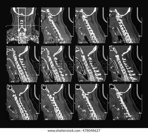 Ct Scan Cervical Spine Cspine Cspine Foto De Stock 478048627 Shutterstock