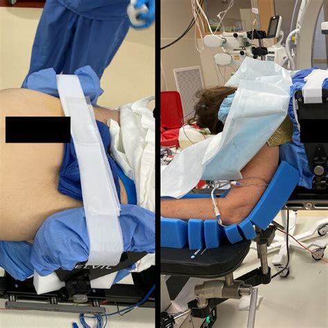 Intraoperative Images Depicting Standard Prone Patient Positioning