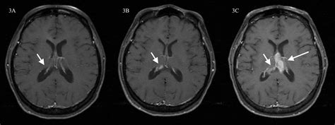 Cureus Long Term Survival In A Patient With Butterfly Glioblastoma A