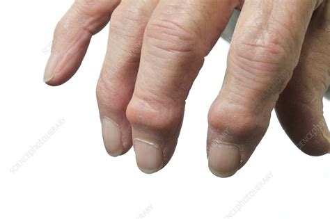 Osteoarthritis Of The Hand Stock Image C Science Photo Library