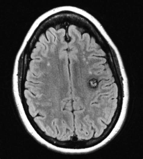Increased Number Of White Matter Lesions In Patients With Familial