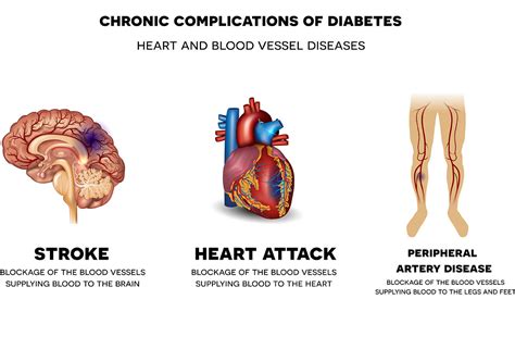 Heart Disease And Stroke Definition