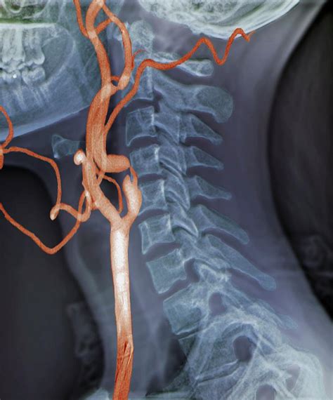 They originate from the carotid bifurcation, travel through the. Stenosis Of Carotid Artery Photograph by Zephyr/science Photo Library