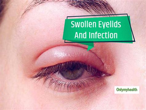 Why You Shouldnt Ignore Those Early Morning Swollen Eyelids Onlymyhealth