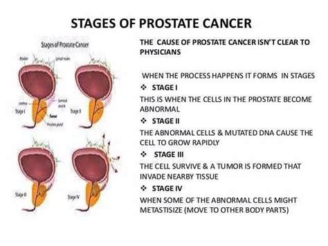Stage 4 Prostate Cancer Symptoms