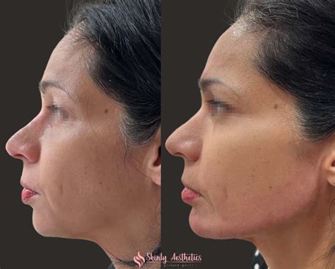 Chin Filler Injections Benefits Cost Results And Procedure Steps