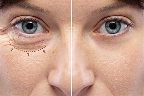 Blepharoplasty Surgery In Mn Healthpartners Plastic Surgery