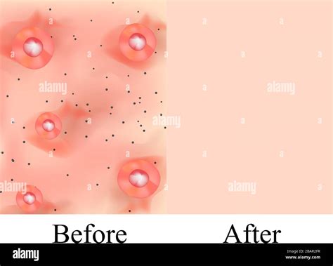 Texture Inflamed Pimples And Acne Before After Acne Cysts Skin