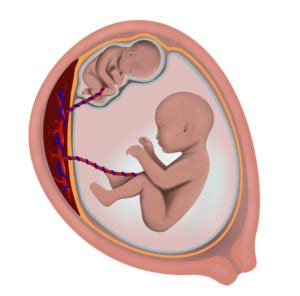 Twin to twin transfusion syndrome (ttts) is a rare condition but also a serious one. Twin-Twin Transfusion Syndrome - Los Angeles Fetal Surgery