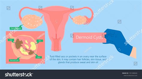 Ovarian Dermoid Cysts Symptoms Of Uterus Cancer Royalty Free Stock