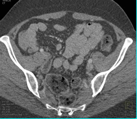 Normal Small Bowel With Neutral Contrast Small Bowel Case Studies