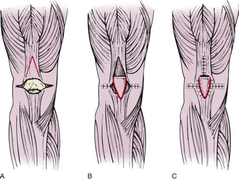 Patella Fractures And Extensor Mechanism Injuries Musculoskeletal Key
