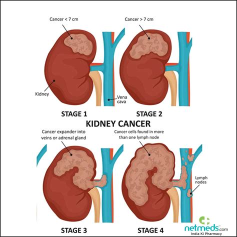 Kidney Cancer As Related To Cancers Pictures