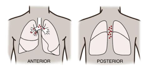 Lung Auscultation Flashcards Quizlet