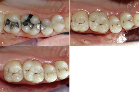 10 Posterior Composite Restorations Pocket Dentistry