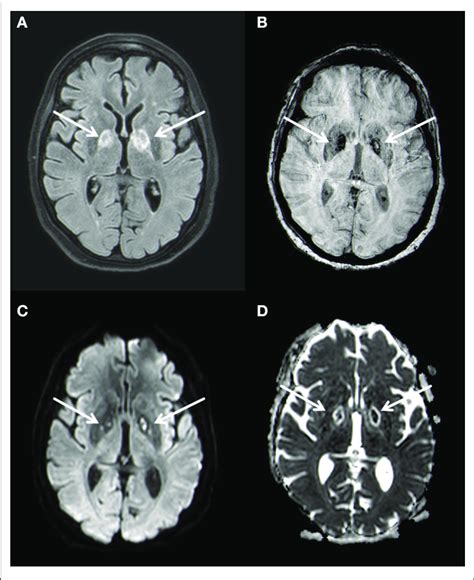 Bilateral Basal Ganglia Necrosis With T2w Hyperintense Alterations