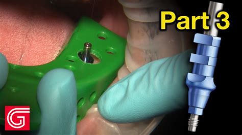 HOW TO Take Implant Open Tray Impression For Tooth YouTube