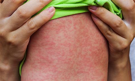 Measles 101 What You Should Know Osf Healthcare