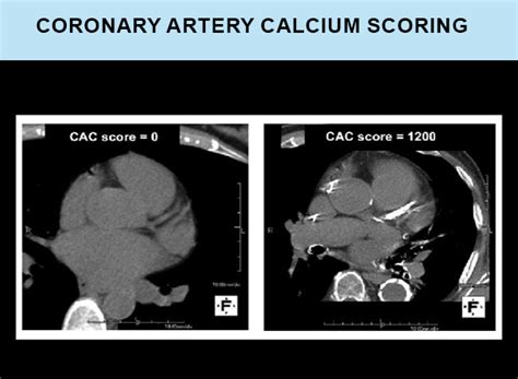 Ct Coronary Artery Calcium Scoring Trust Multispeciality Hospitals