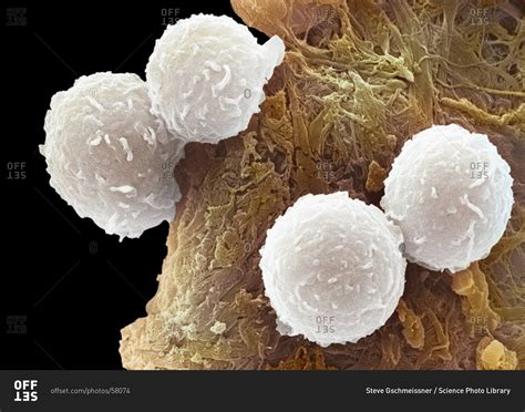 Leukemia White Blood Cells Scanning Electron Microsco