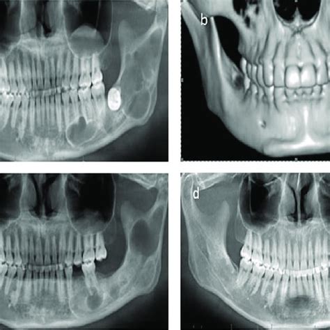 Pdf Recurrence Of Odontogenic Keratocysts And Possible Prognostic