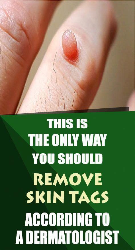 This Is The Only Way You Should Remove Skin Tags According To A