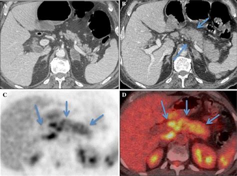 The Role Of 18f Fdg Petct And Petmri In Pancreatic Ductal