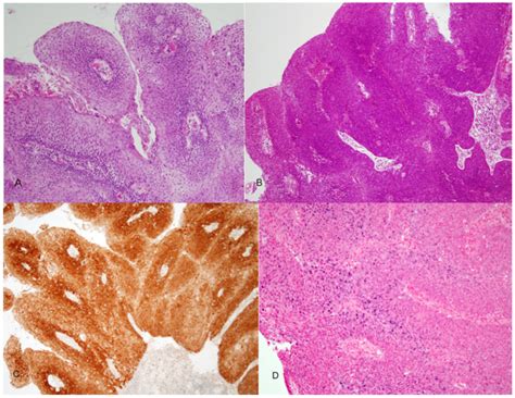 Papillary Squamous Cell Carcinoma A Keratinizing Type The Dysplastic