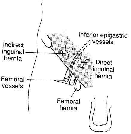 An inguinal hernia occurs when tissue, such as part of the intestine, protrudes through a weak spot in the abdominal muscles. Inguinal Hernias. What is an inguinal hernia? Groin lump | Patient