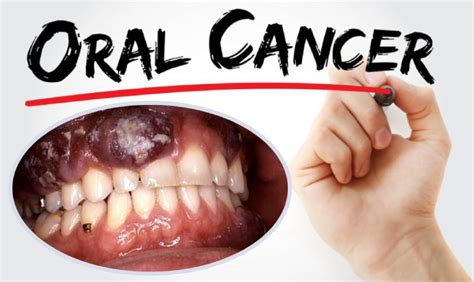 Král Lear Rohož Diktovat Oral Cancer On Gums Táto Oblázek útes