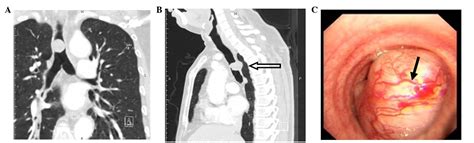 Optimal Treatment For Primary Benign Intratracheal Schwannoma A Case Report And Review Of The