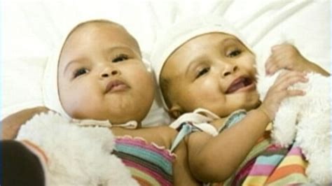 Conjoined Twins The Ethical Implications Of Separation