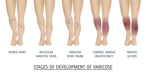 Varicose Veins A Detailed Guide Answering All Your Questions