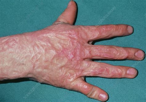 Burns Severe Scarring On Hand Of Boy Aged 9 Stock Image M3350085