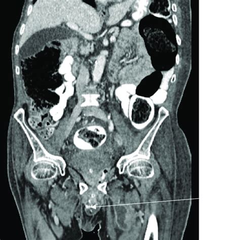 Ct Scan Of The Abdomen And Pelvis With Iv Oral And Rectal Contrast