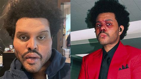 Full Story Behind The Weeknds Face Bandages At Super Bowl Lv