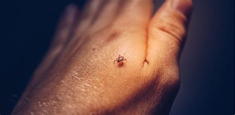 Dept Of Health Warns Public About Rocky Mountain Spotted Fever Colorado Tick Fever Sheridan