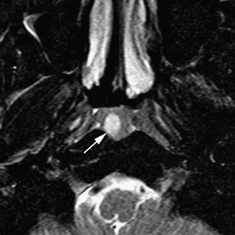 Pdf Nasopharyngeal Cystic Lesions Tornwaldt And Mucous Retention