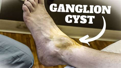 HUGE Ankle Ganglion Cyst Aspiration Surgery Foot Ankle Treatment YouTube