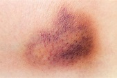 Bruises – What They Are and How to Treat - Dr. Lauri Grossman