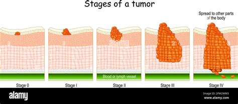 Stades Du Cancer Classification Des Tumeurs Malignes De 0 à 4