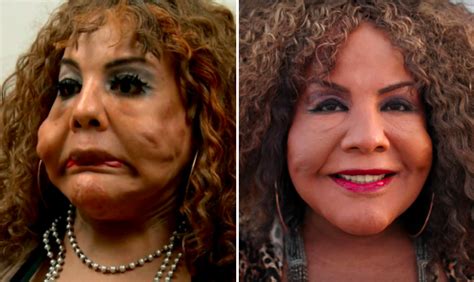 Bad Plastic Surgery Before And After 17 Celebrity Before And After