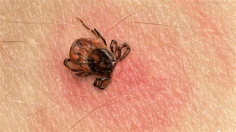 Tick Bites In Children Treatment Symptoms And Removal What To Expect