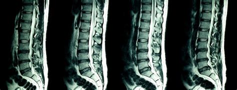 Premium Photo Mri Scan Of Lumbar Spines Of A Patient With Chronic