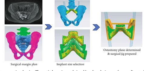 Figure 3 From Use Of A 3d Printed Patient Specific Surgical Jig And