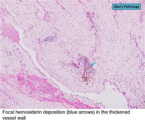 Pathology Outlines Venous Hemangioma