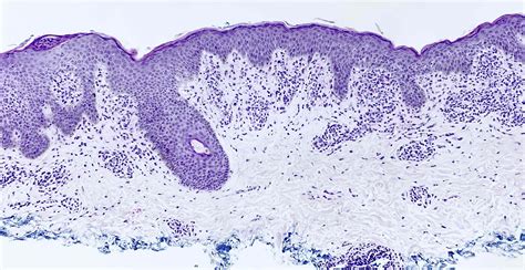 Pathology Outlines Erythema Annulare Centrifugum