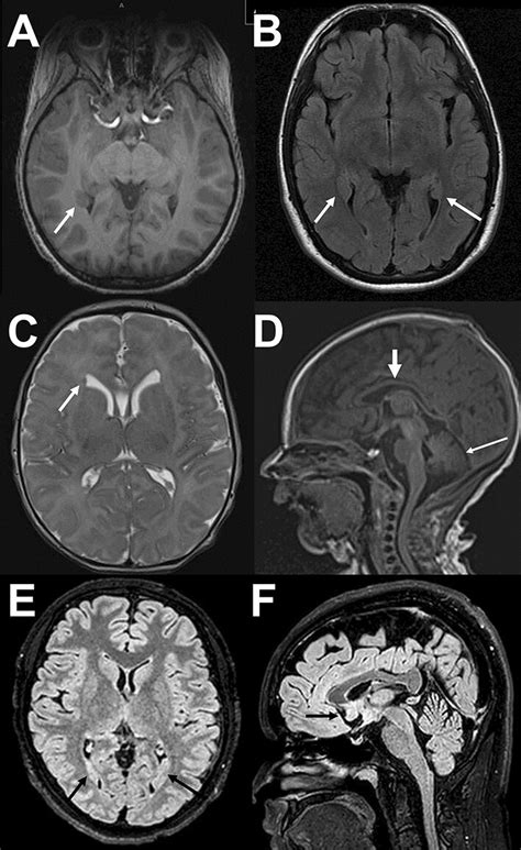 Examples Of Brain Malformations Patterns A Patient 3 At Age 9 Y